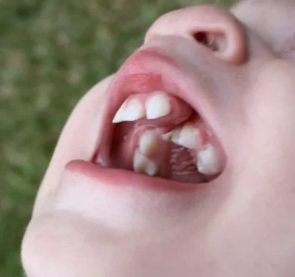 علاج وتجميل الشفة الارنبية