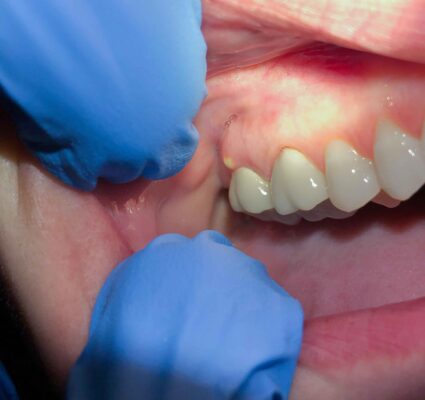 علاج الاكياس الدهنية وأورام الفكين