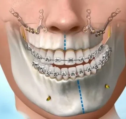 التقويم الجراحي للفكين