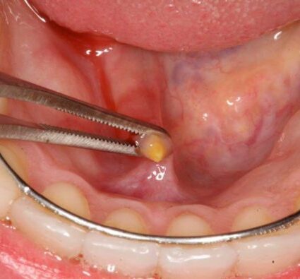 ⁠استئصال الغدد اللعابية وحصوات الغدد اللعابية